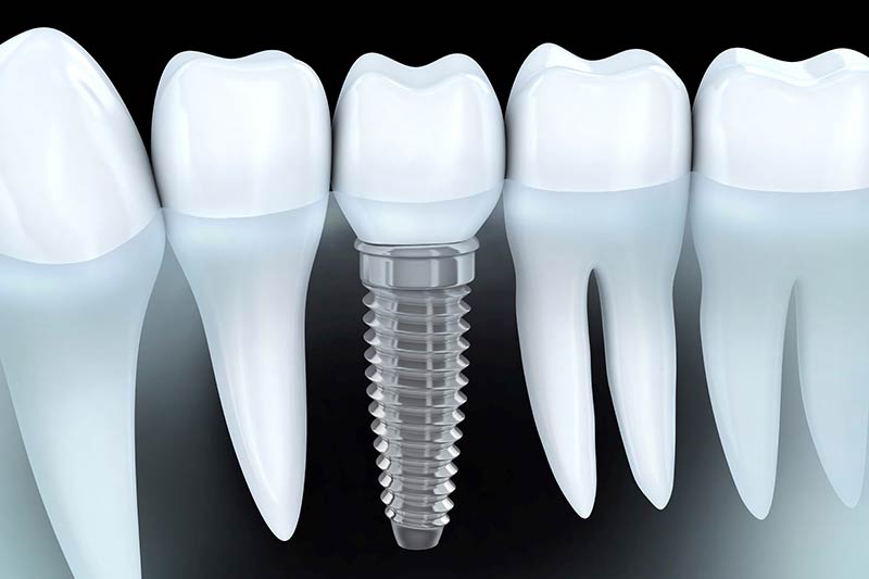 implantologia-dentista-odontoiatria-biella
