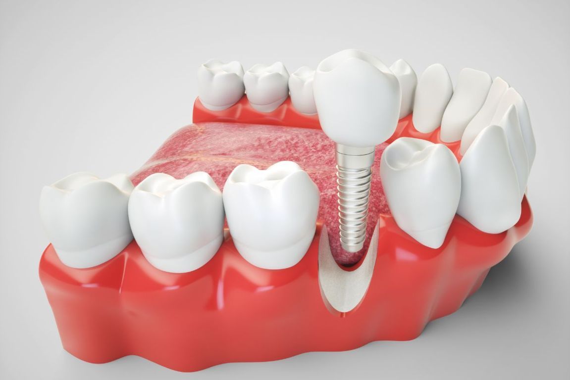 osteointegrazione impianto dentale